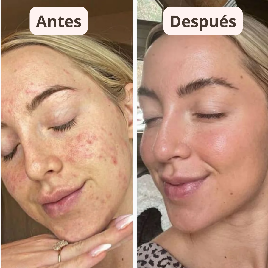 PureSkin™ – Sérum Exfoliador Anti Puntos Negros