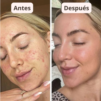 PureSkin™ – Sérum Exfoliador Anti Puntos Negros