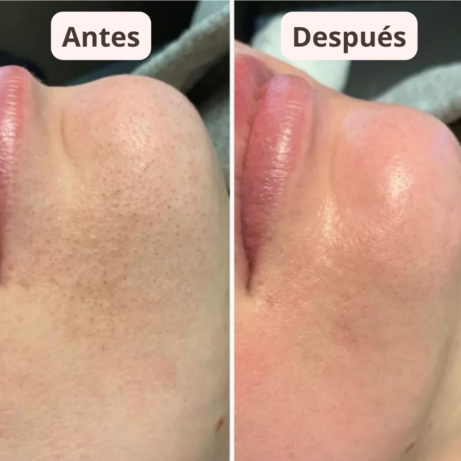PureSkin™ – Sérum Exfoliador Anti Puntos Negros