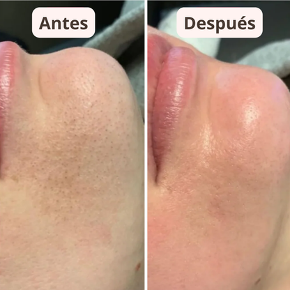 PureSkin™ – Sérum Exfoliador Anti Puntos Negros