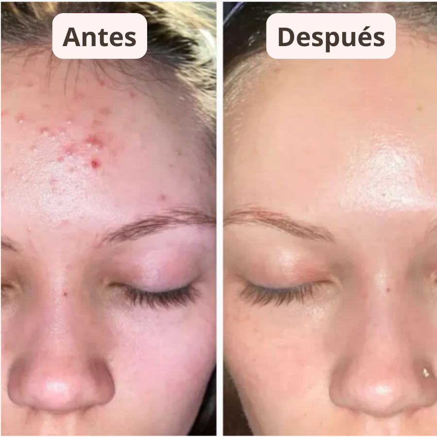 PureSkin™ – Sérum Exfoliador Anti Puntos Negros